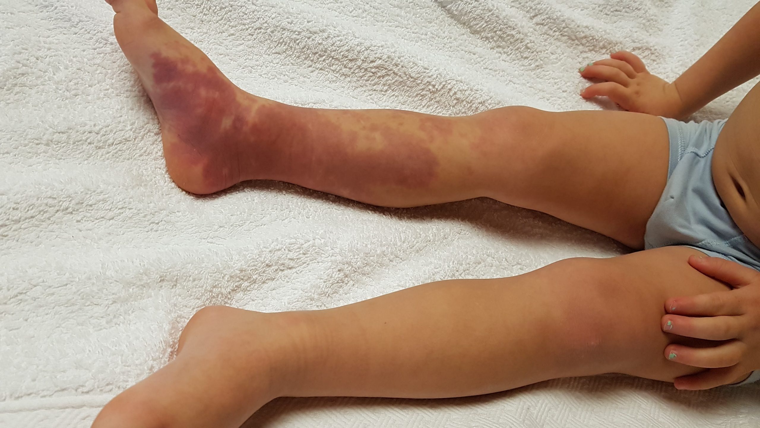 dcmo1 Diffuse Capillary Malformation with Overgrowth (DCMO)