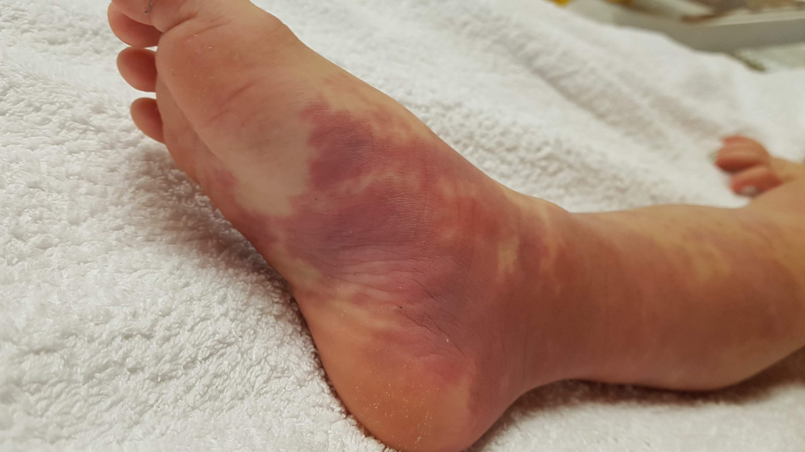 dcmo2 Diffuse Capillary Malformation with Overgrowth (DCMO)