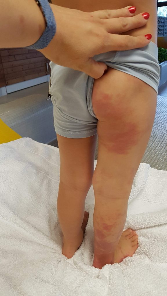 Diffuse Capillary Malformation with Overgrowth (DCMO)