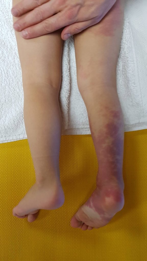 Diffuse Capillary Malformation with Overgrowth (DCMO)