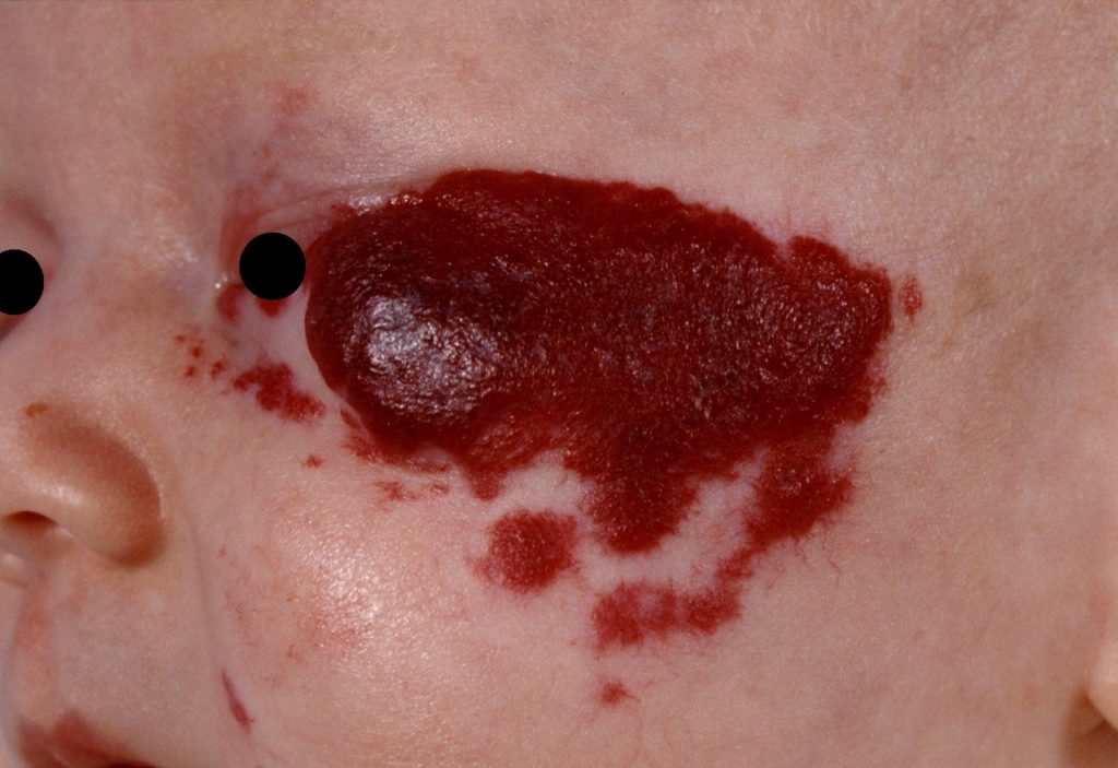Hemangioma