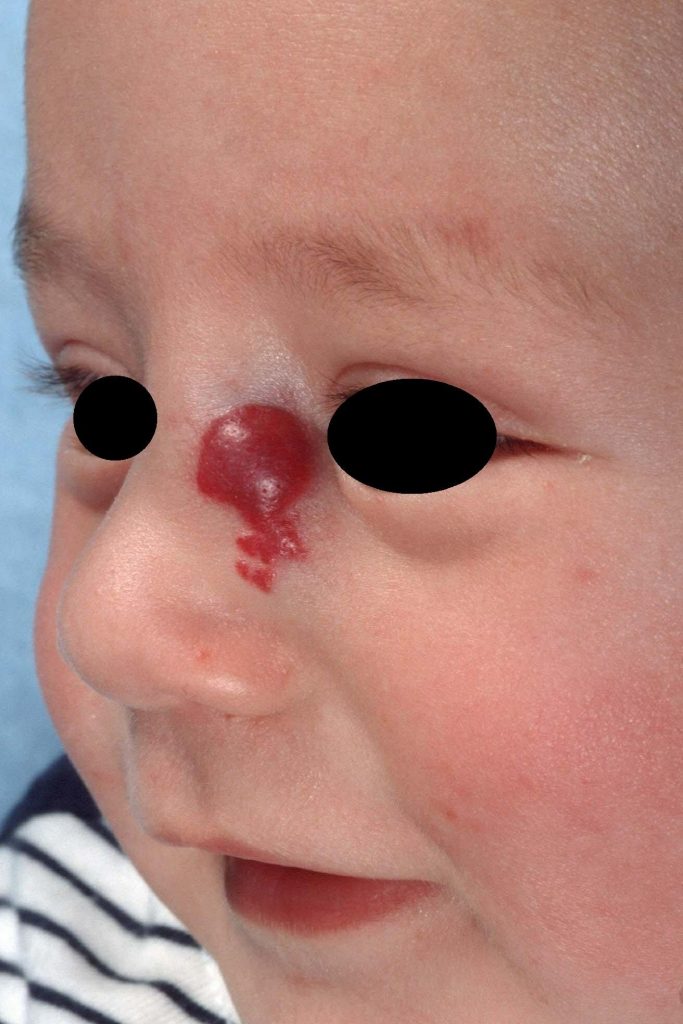 Hemangioma