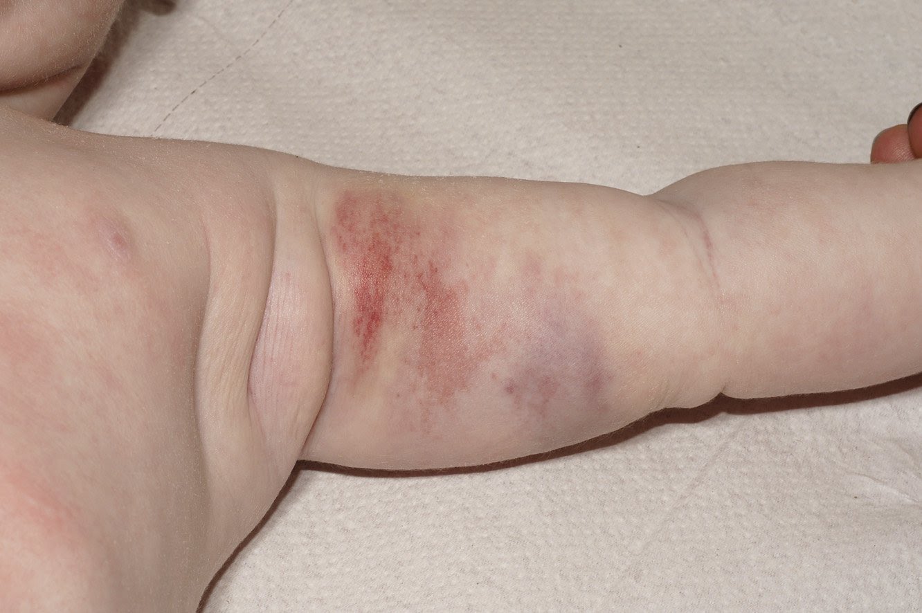 Hemangioma-endothelioma