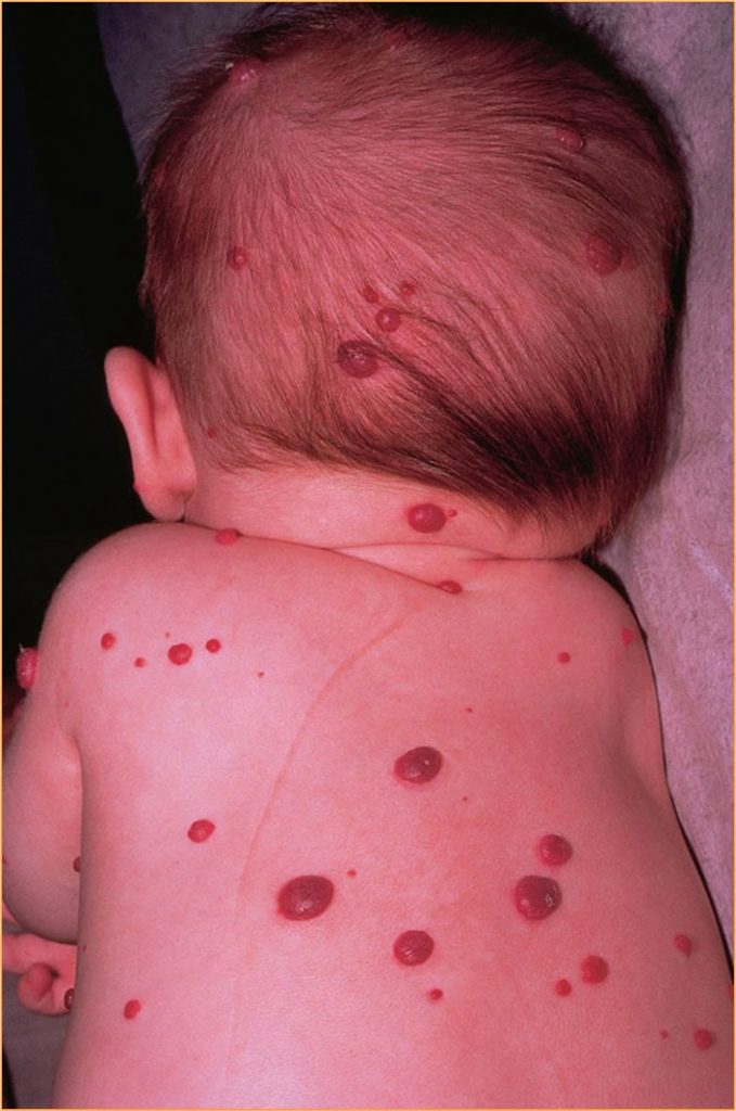 Hemangioma