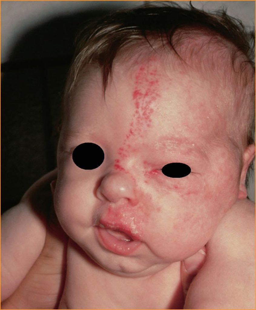 Hemangioma