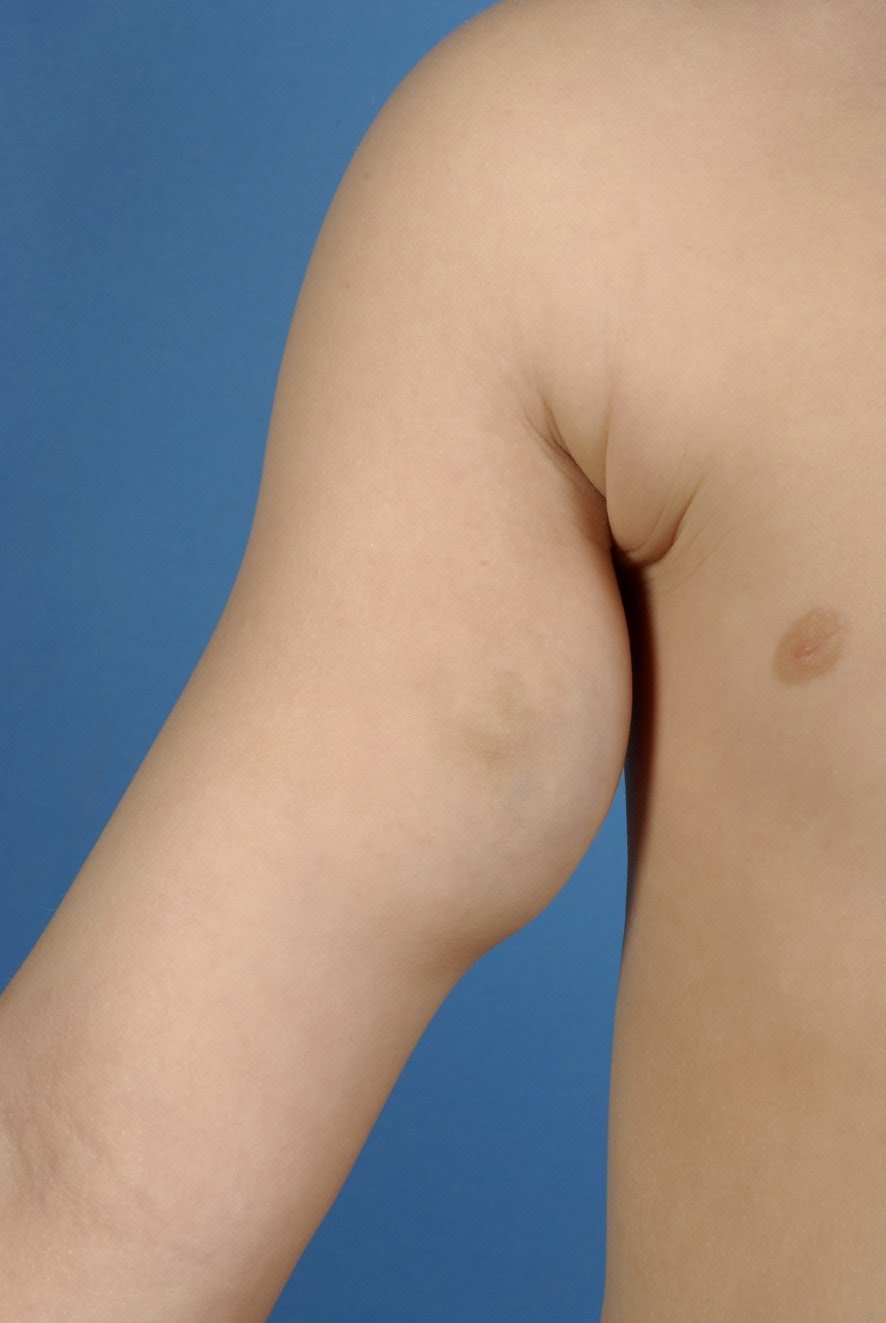 lm1 Lymphatic malformation