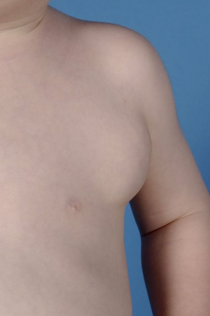 Lymfatic malformation