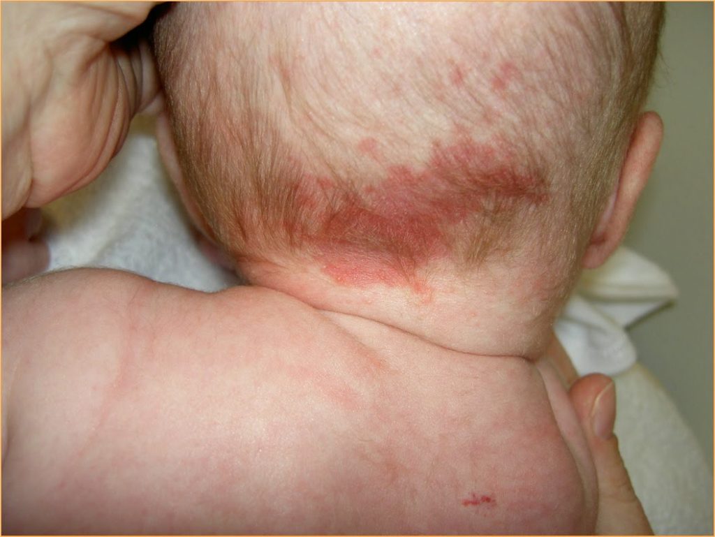 Stork bite