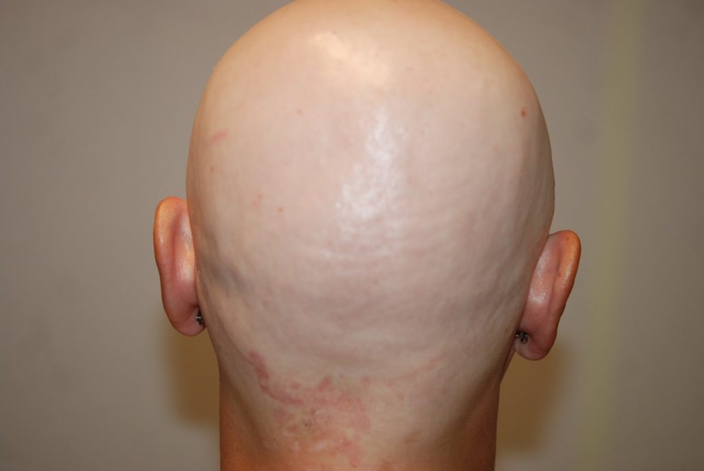Stork bite