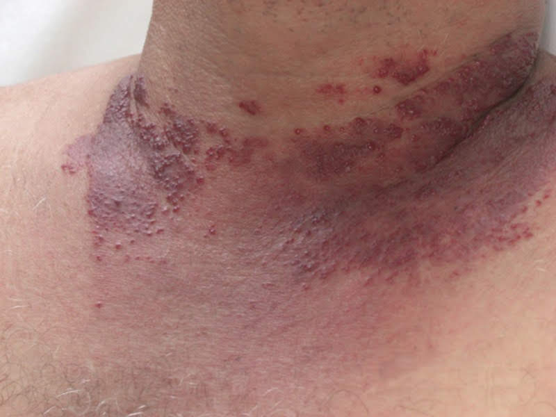 tufted-angioma Hemangioma