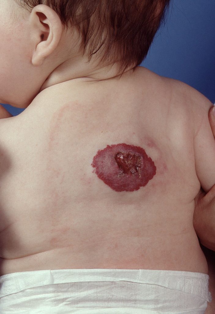 Hemangioma