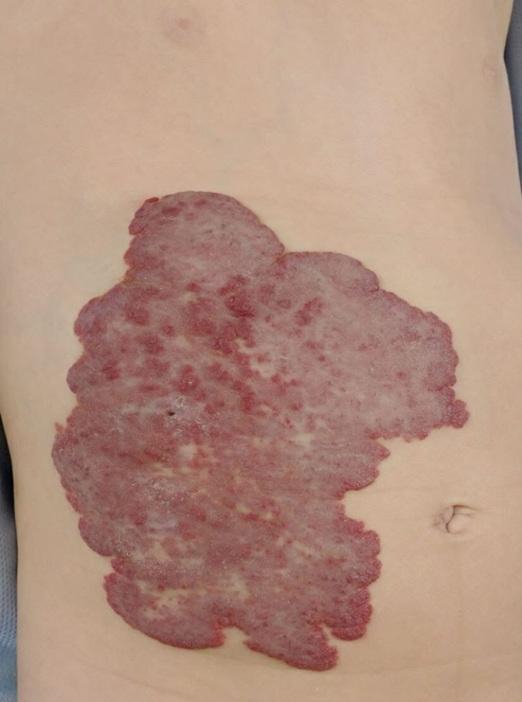Hemangioma
