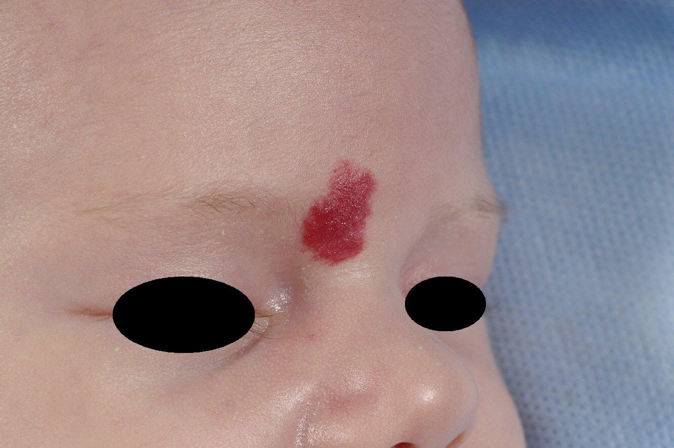 vlak-hemangioom hemangioma