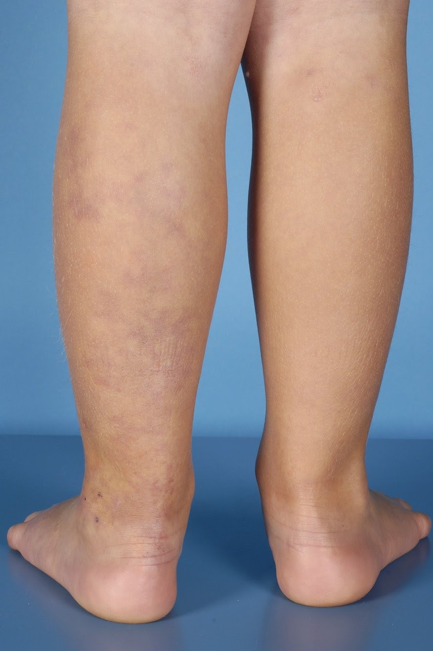 vm1 Venous malformation