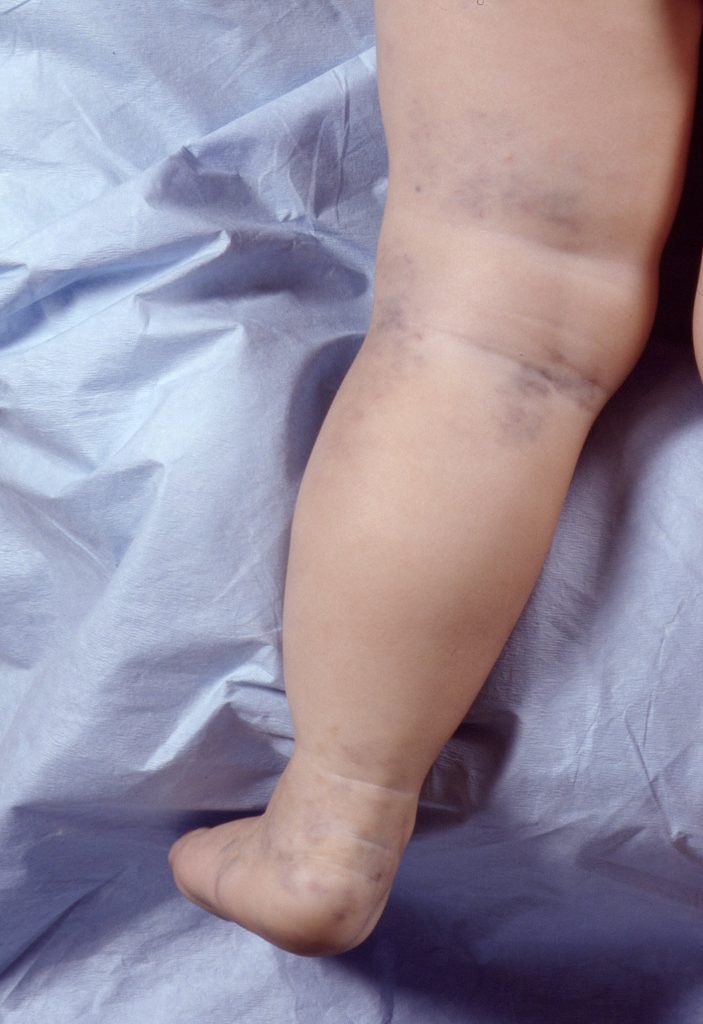 Venous malformation