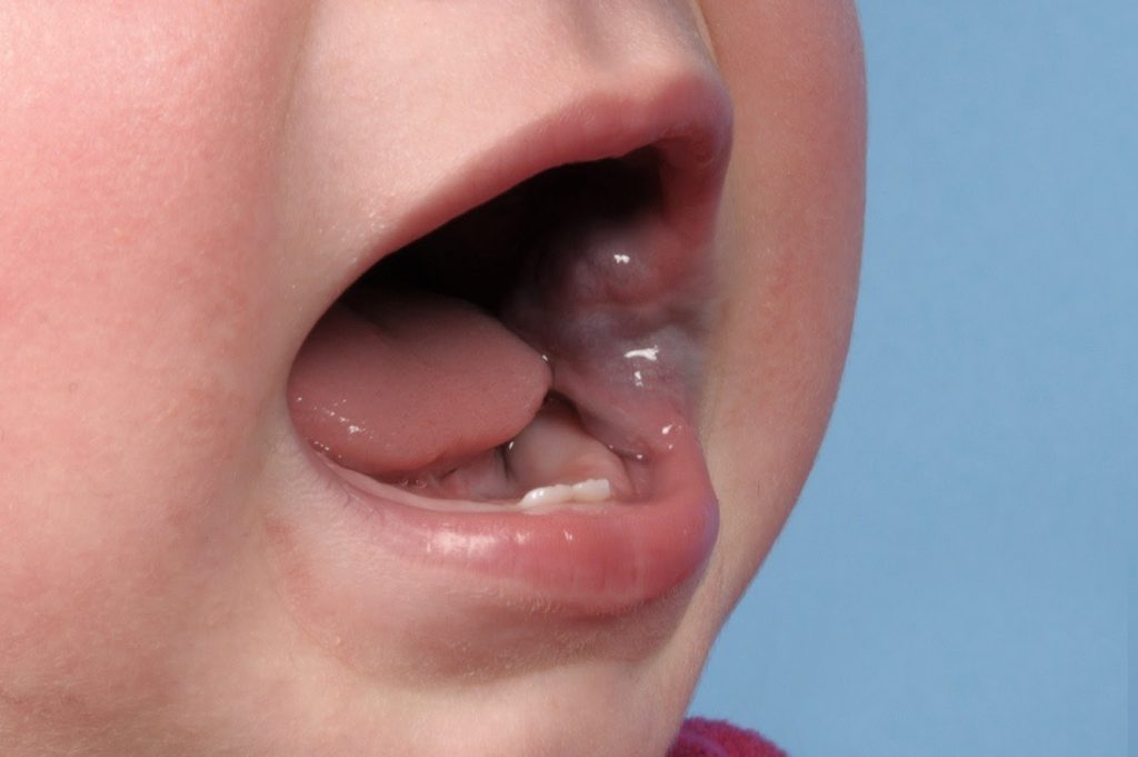 Venous malformation