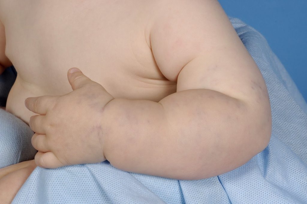 Venous malformation